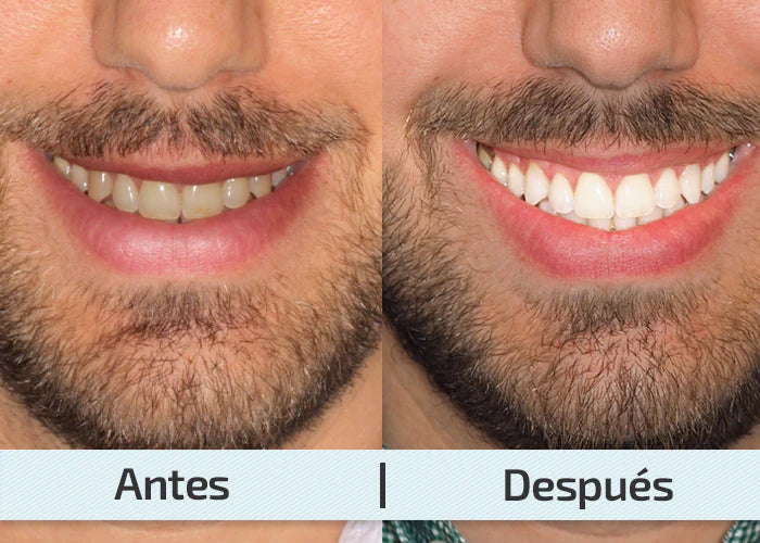 Blanqueador Dental con Luz UV PREMIUM